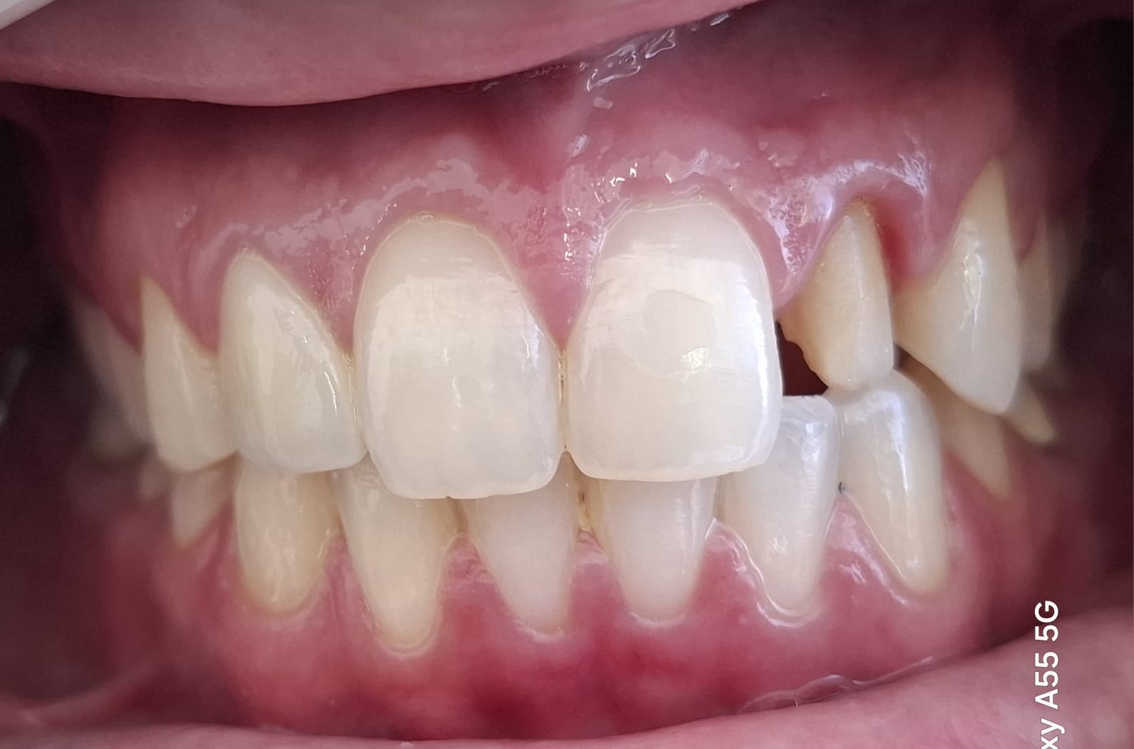 Antes - Reabilitação Estética Anterior