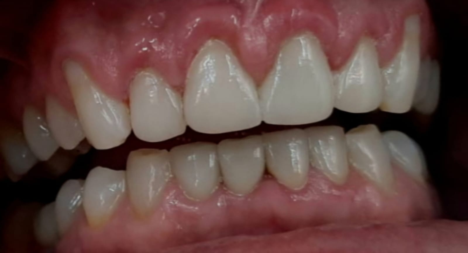 Depois - Reabilitação Completa Superior