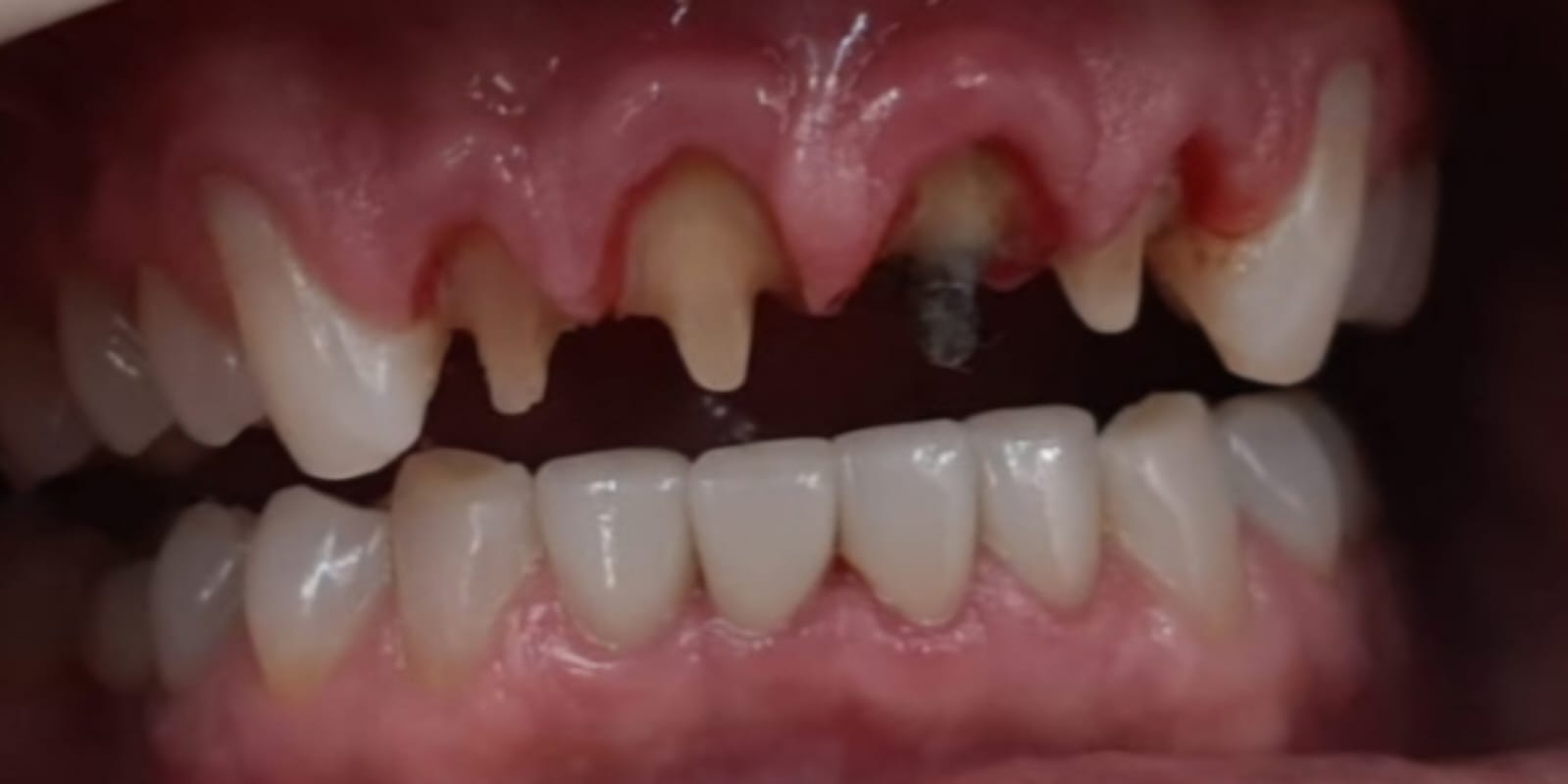 Antes - Reabilitação Completa Superior